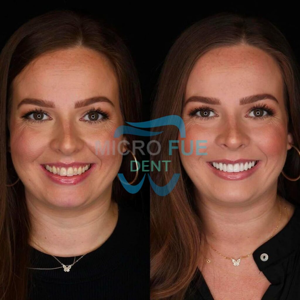 20 Emax Veneer in Antalya Before After