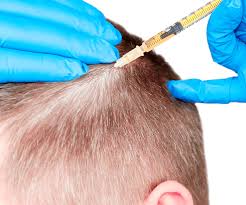 Stem Cell Injection for Hair Loss