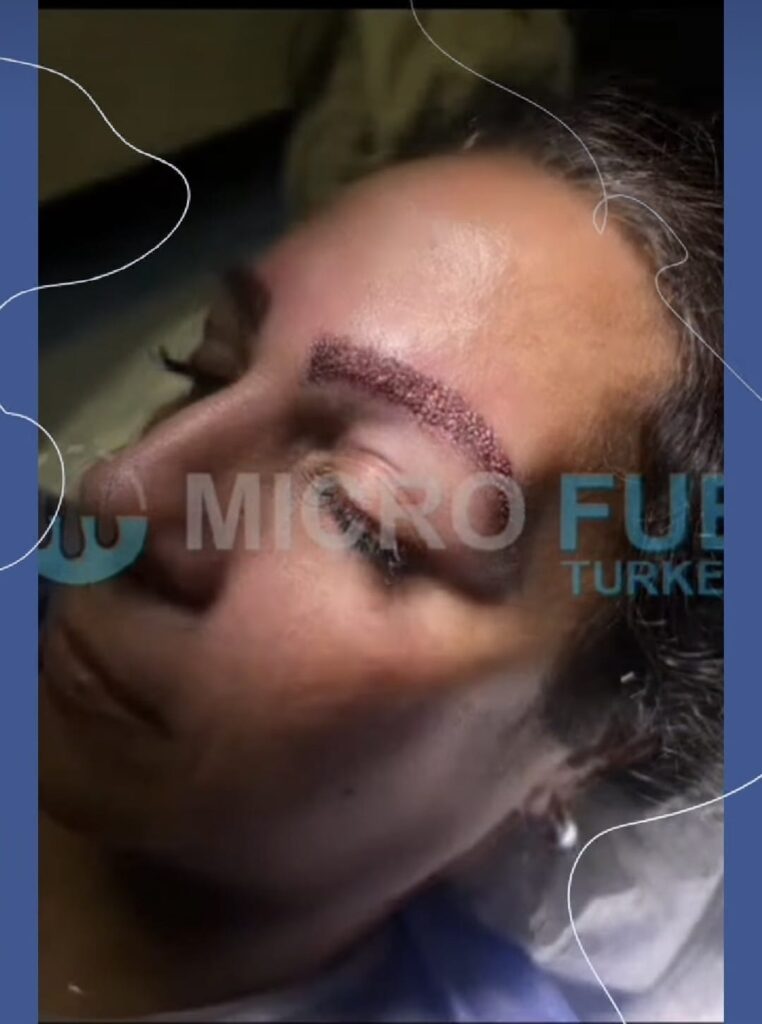 Eyebrow Transplant Process and Recovery