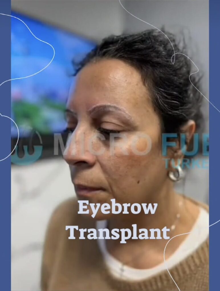 Eyebrow Transplant Turkey