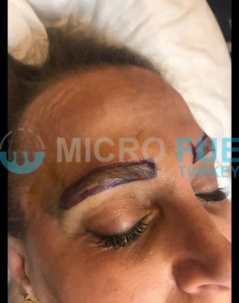 How Long is the Healing Process for Eyebrow Transplant?