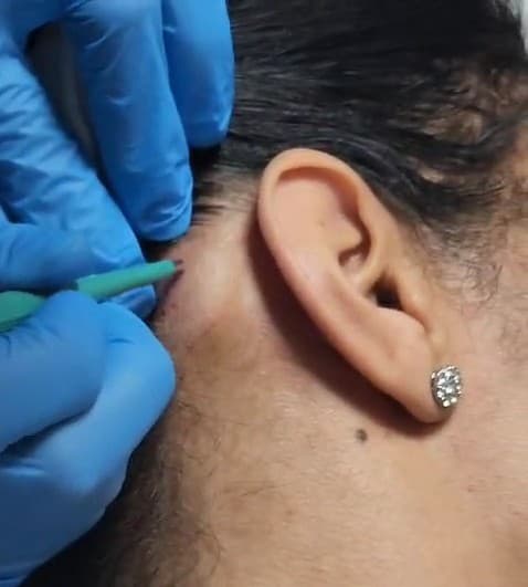 Exosome Treatment in Fethiye