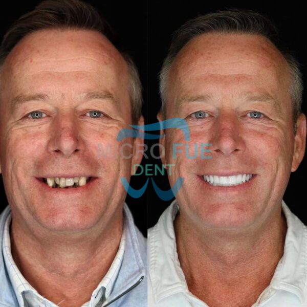 10 Implant 24 Zirconium Crown in Antalya