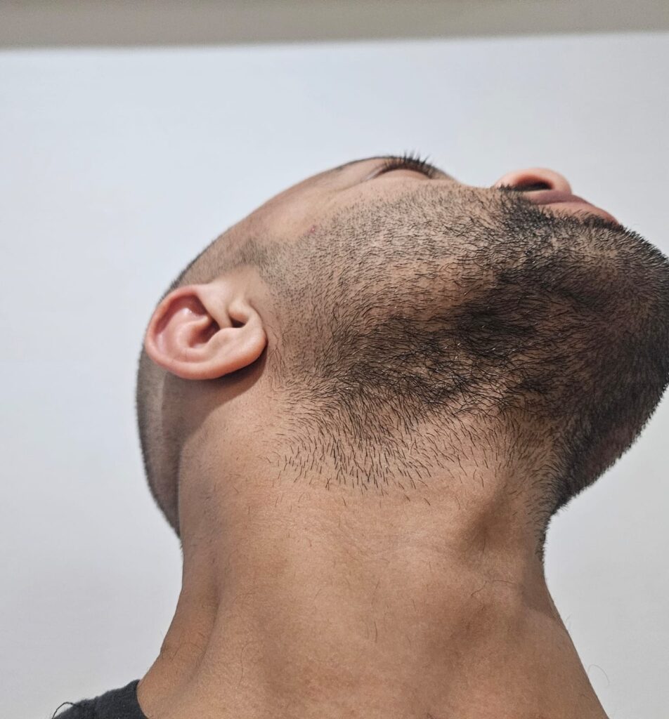 Beard Hair for Hair Transplant
