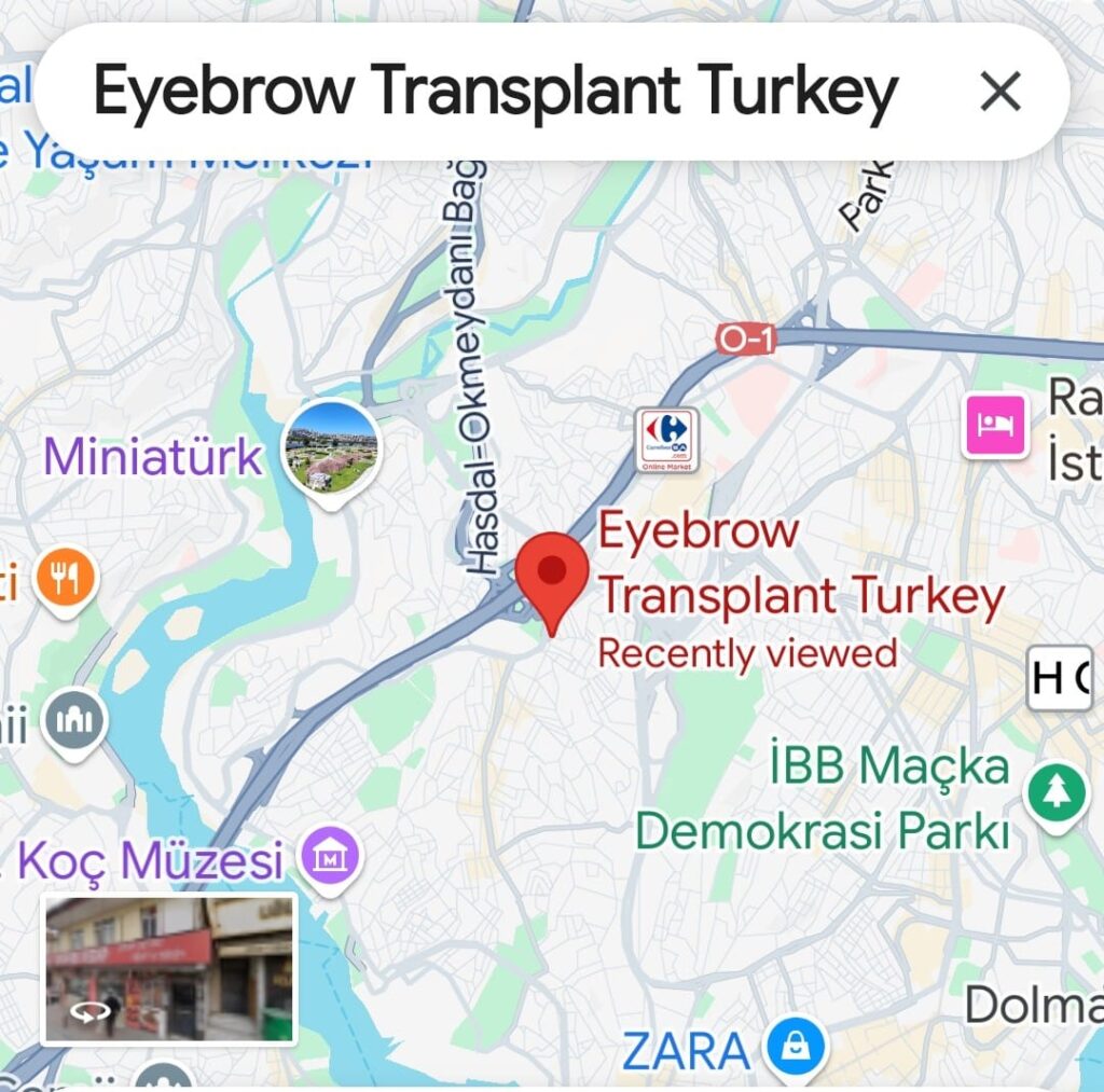Как пройти пересадку бровей в Турции