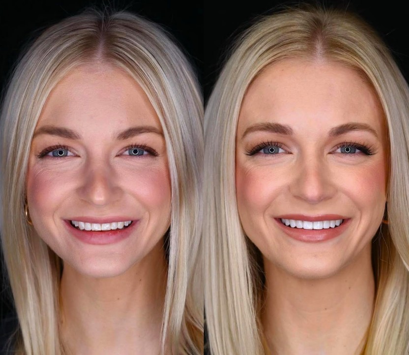 20 Laminate Veneer in Sisli Before After