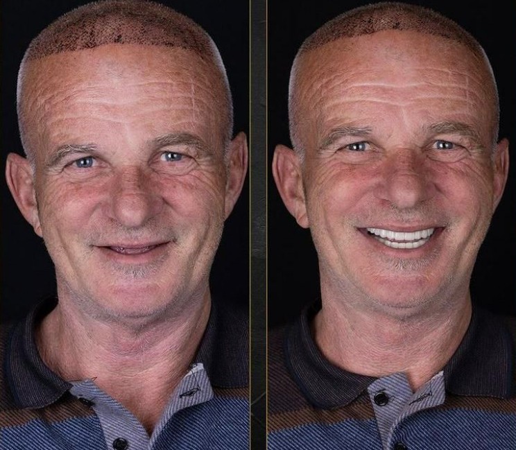 Быстрое Стоматологическое Лечение в Анталье