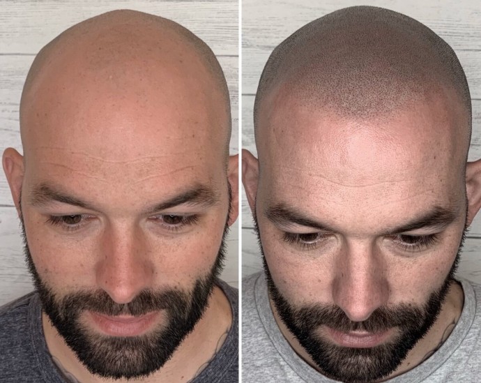 Eyebrow & Scalp Micropigmentation in Marmaris, Bodrum & Fethiye