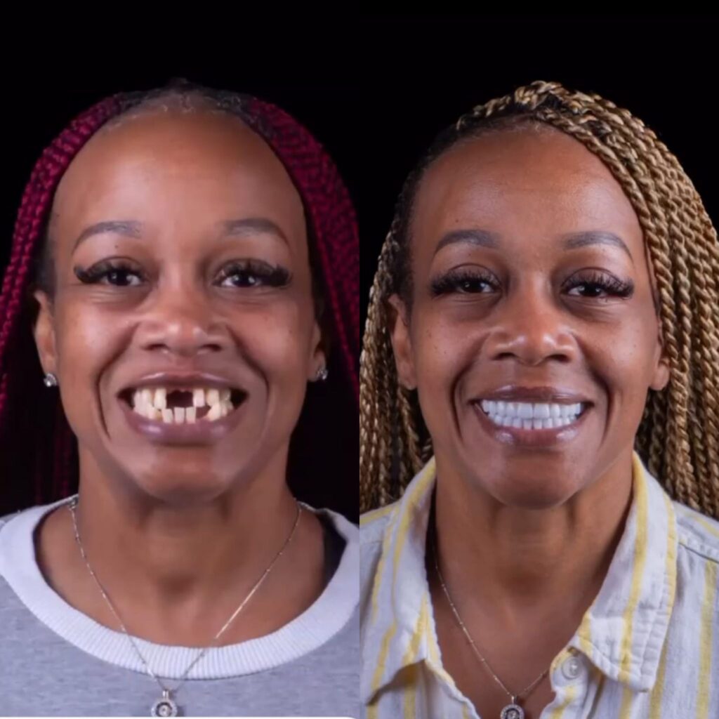 Dental Implants in Şişli, Istanbul