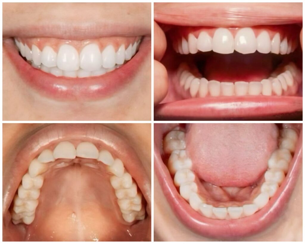 Emax Veneer in Sisli