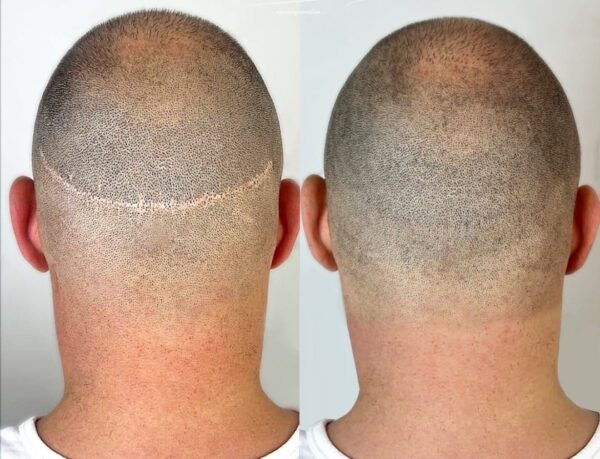Scalp Micropigmentation in Şişli, Istanbul