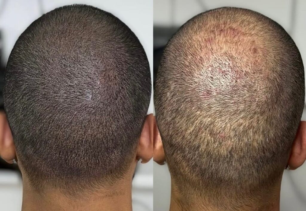 Scalp Micropigmentation in Şişli, Istanbul