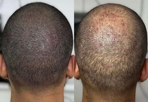 Scalp Micropigmentation in Şişli, Istanbul