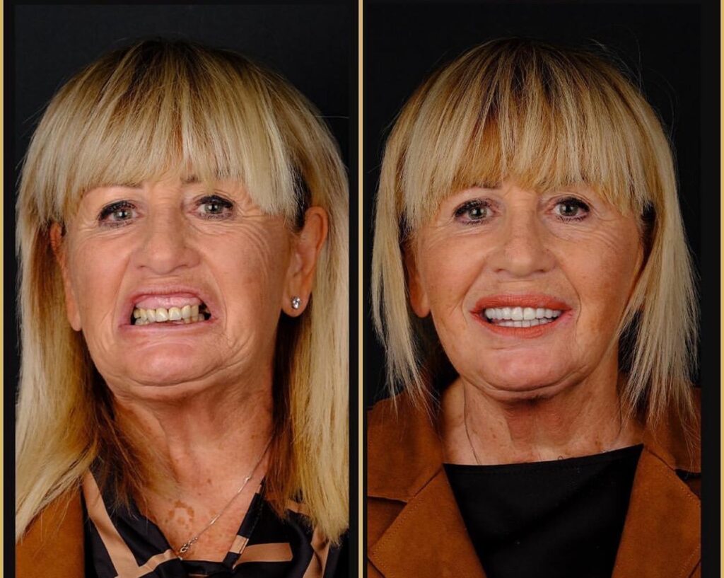 Affordable 8 Implants and 24 Zirconium Crowns in Şişli with Micro FUE Turkey