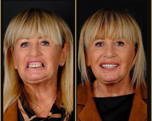 Affordable 8 Implants and 24 Zirconium Crowns in Şişli with Micro FUE Turkey