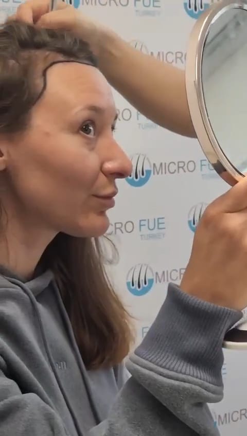 3-Day Hair Transplant Experience in Istanbul