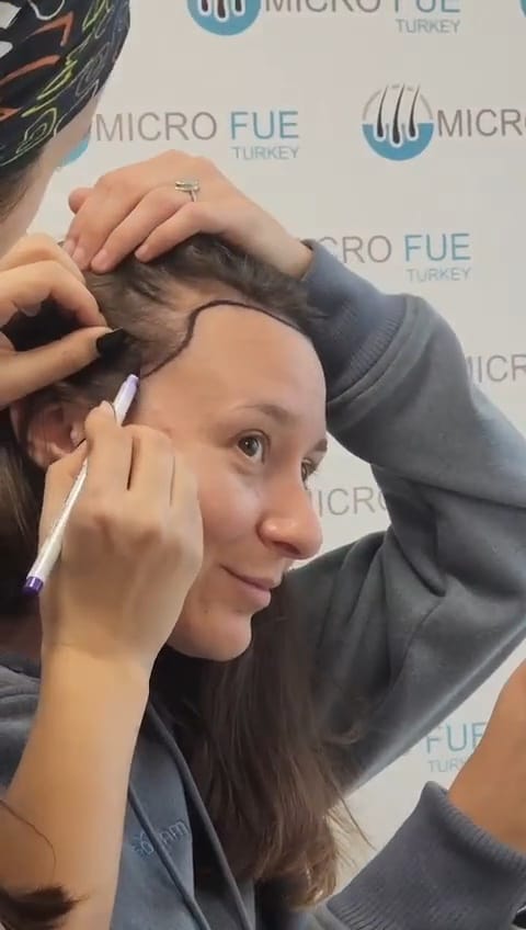 Hair Transplant Process for Women in Turkey