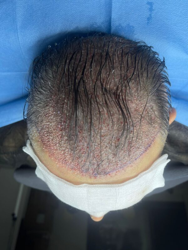 After Hair Transplant