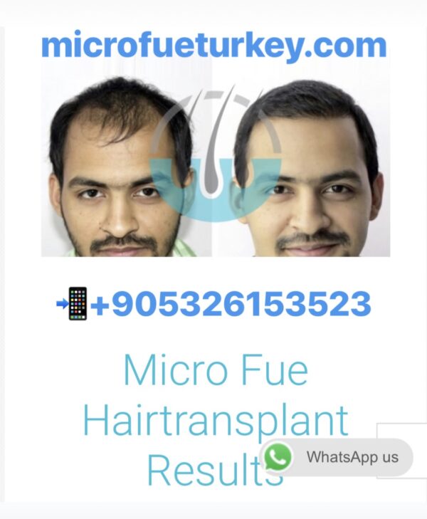 FUE против DHI