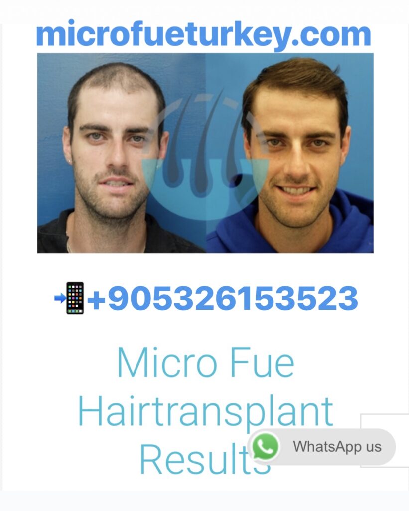 Best Hair Transplant in Istanbul