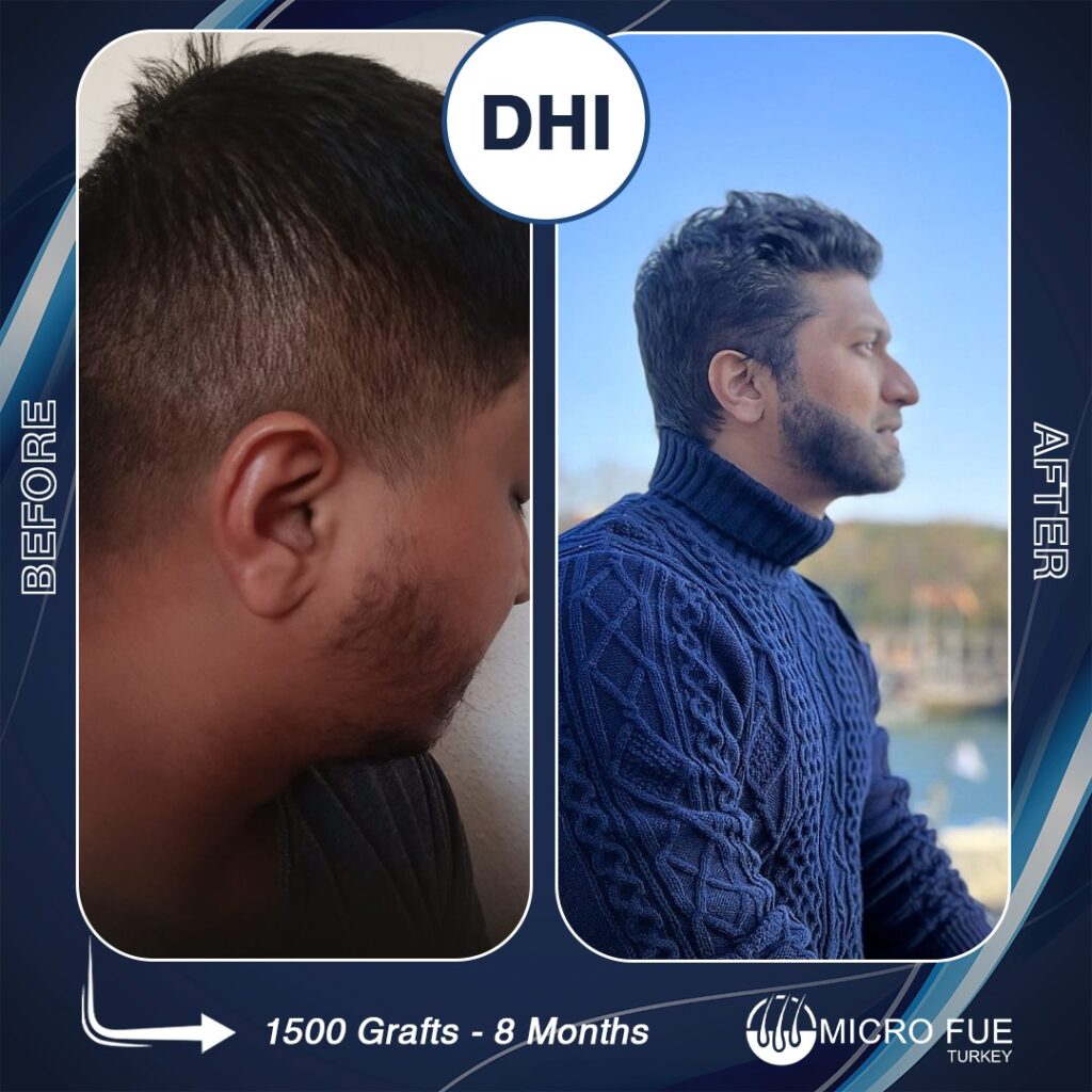 Beard transplant in İzmir