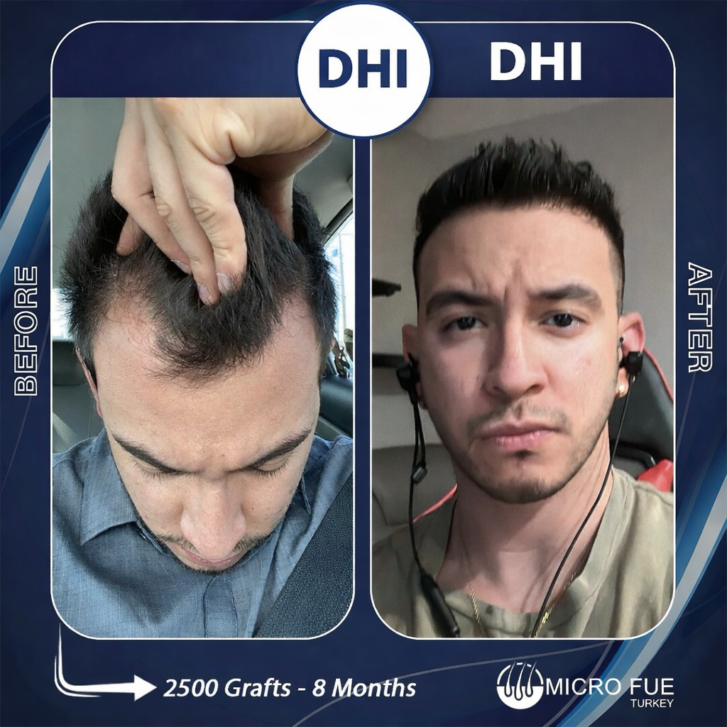 DHI hair transplant before and after results USA patient Andrea Parlonic at Micro FUE Turkey