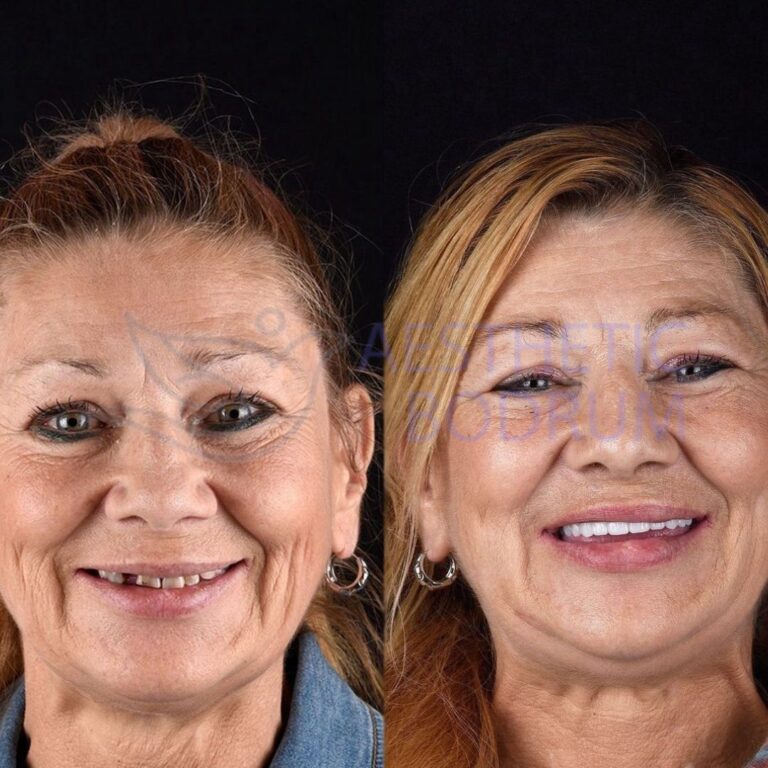 British dental implant patient smiling after successful full mouth dental implants treatment in Antalya Turkey