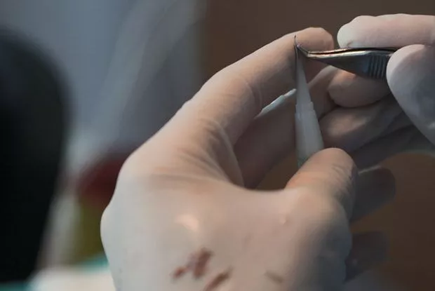 DHI hair transplant Choi implanter pen procedure at Micro FUE Turkey clinic