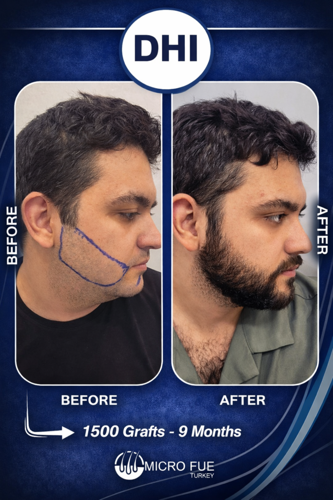 Daniel Martinez United States beard transplant before and after Turkey FUE beard transplant natural results high density transformation